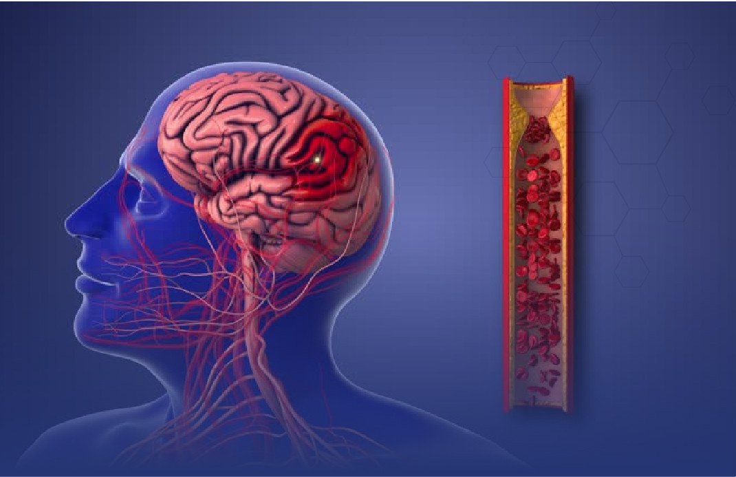 Avoiding Stroke: A Hypertension Patient’s Guide to Reducing Clot Risks - تجنب السكتة الدماغية: دليل مريض الضغط لتقليل خطر الجلطات